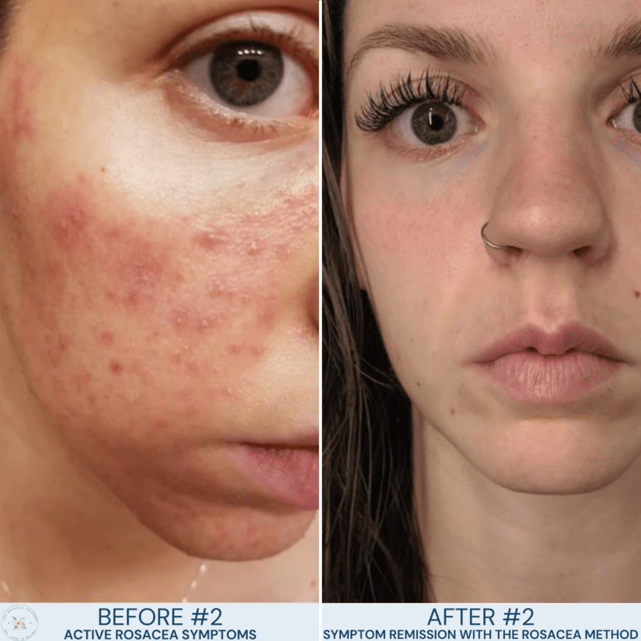 Side-by-side comparison of a holistic rosacea client before and after completing Dr. Tara O’Desky’s root-cause healing program.