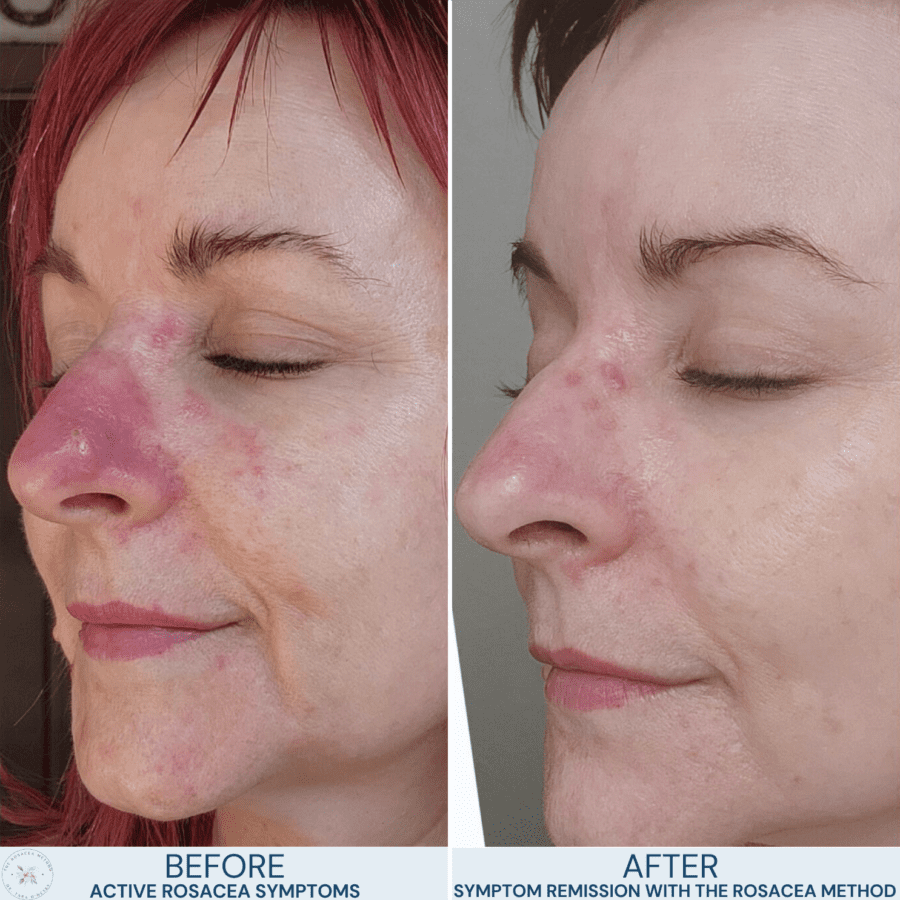 A client’s holistic rosacea transformation after addressing gut health and inflammation with Dr. Tara O’Desky’s The Rosacea Method.
