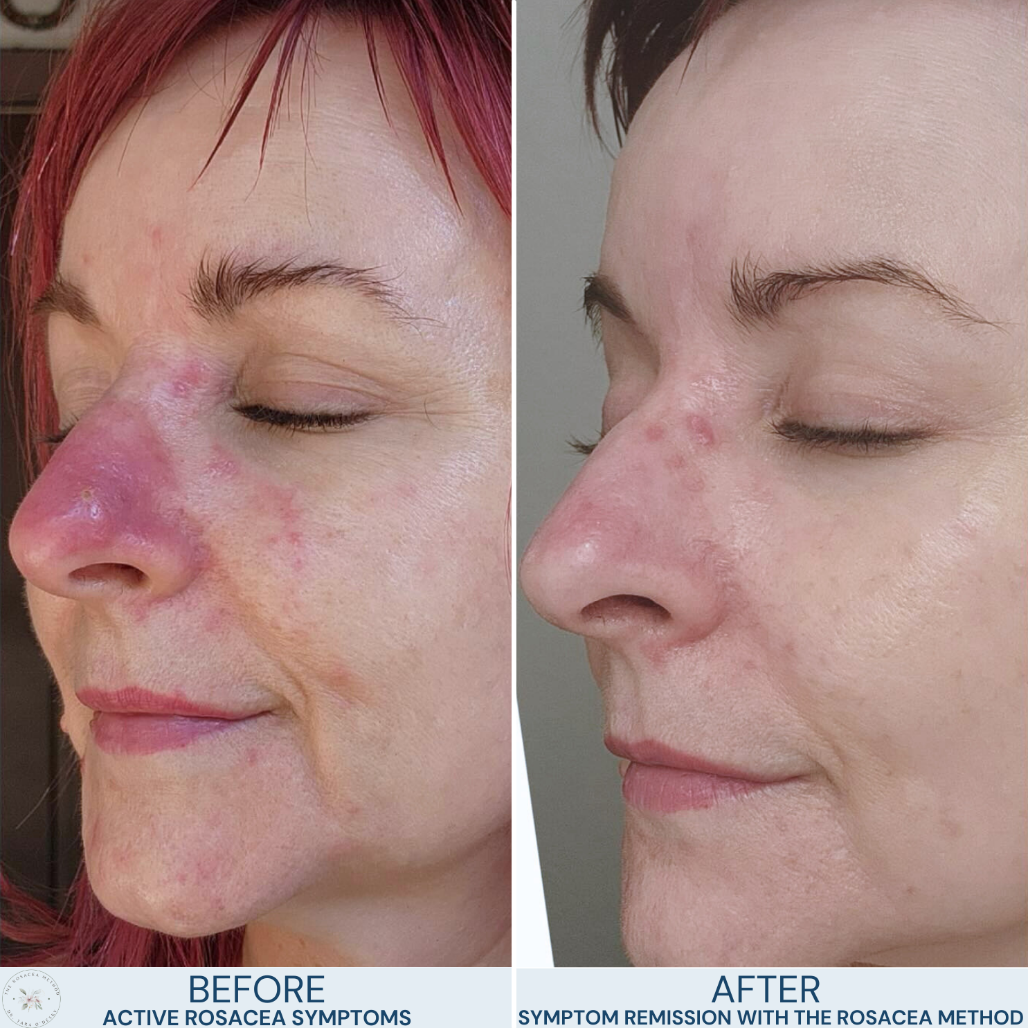 A client’s holistic rosacea transformation after addressing gut health and inflammation with Dr. Tara O’Desky’s The Rosacea Method.