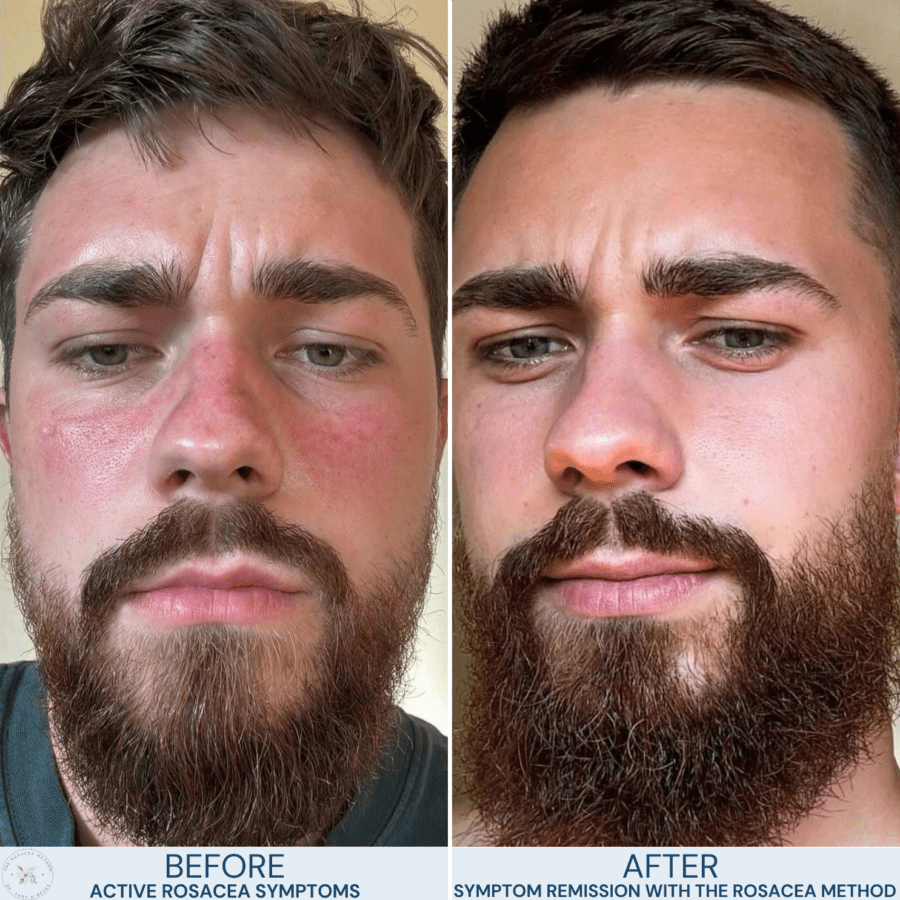 Before-and-after results of a holistic rosacea client who achieved clearer skin through The Rosacea Method by Dr. Tara O’Desky, reducing redness naturally.