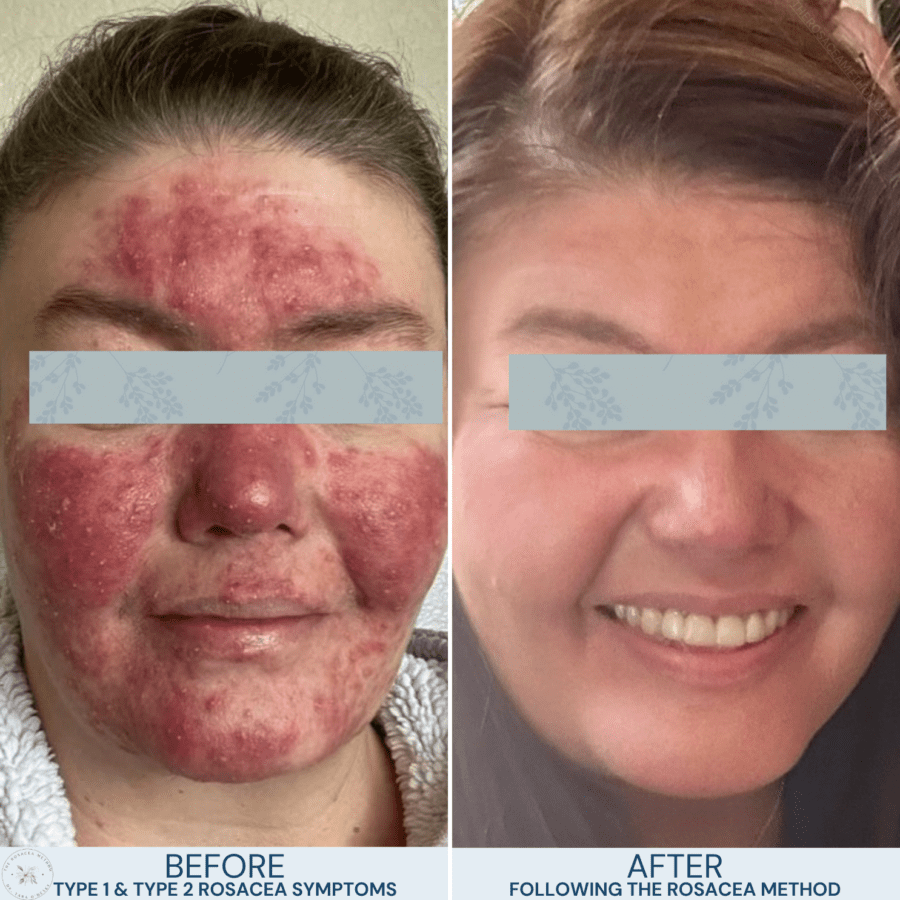 A client’s natural healing for rosacea improvement after following The Rosacea Method, clearing their skin naturally without medications.