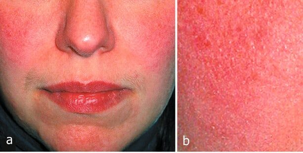 Close-up photos showing facial redness diagnosed as rosacea with fine follicular scaling from Demodex mites, illustrating the connection explored in “ can mites cause rosacea ."